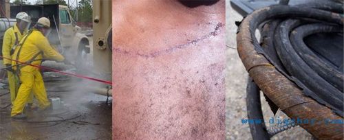 高壓水射流造成的傷害